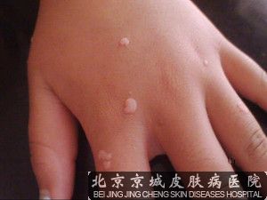扁平疣治疗方法