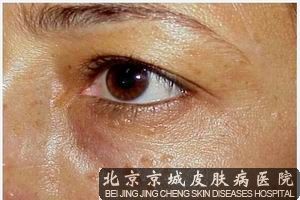 汗管瘤该如何治疗