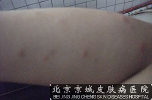 荨麻疹怎么治疗