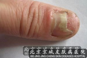 灰指甲症状的分类