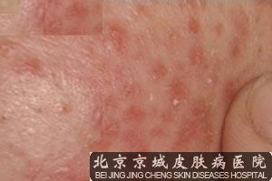 皮肤过敏怎么办