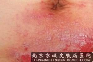 疥疮是什么引起的