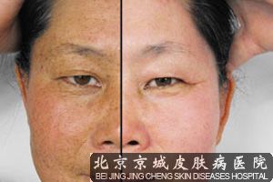 雀斑能去掉吗