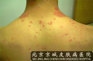 药疹和药物过敏有区别吗