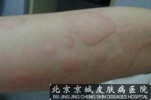 夏季如何护理荨麻疹