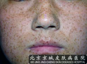 脸上长雀斑怎么办