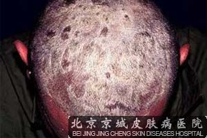 选择牛皮癣偏方的基本原则