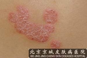银屑病终于 了