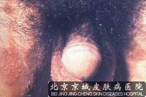 阴囊湿疹的症状 