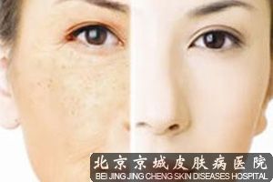 雀斑的治疗方法有什么