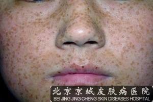 什么引起脸上雀斑的