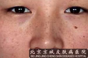 雀斑出现的原因