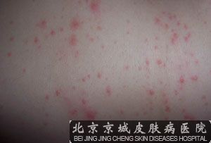 预防荨麻疹的日常注意事项