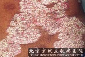 工作环境是导致牛皮癣的因素吗