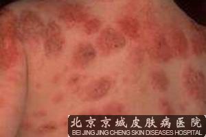 神经性皮炎的预防措施