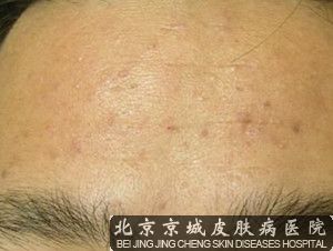 扁平疣治疗偏方勿轻信
