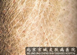 鱼鳞病的遗传方式
