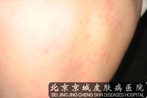 治疗荨麻疹方法方法是什么