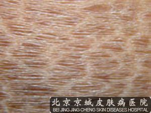 鱼鳞病会导致哪些并发症
