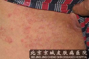 得了股癣怎么办