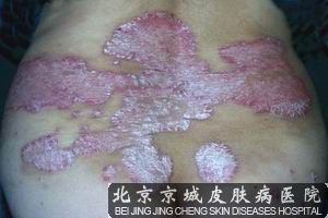 牛皮癣什么引起的