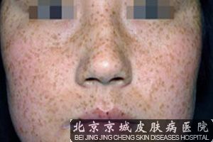 生活中哪些不良习惯会引起雀斑