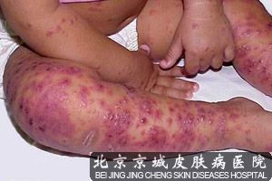 急性湿疹的症状表现