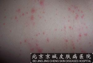 北京治疗荨麻疹去哪里