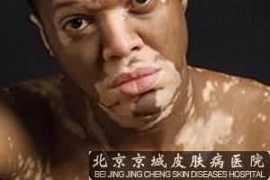 白癜风是否传染