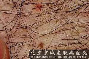 阴虱用什么药