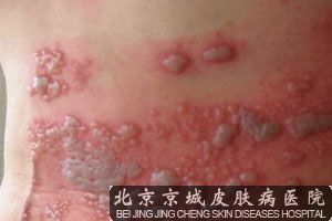 带状疱疹后遗神经痛治疗