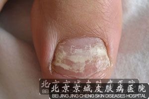 如何根治灰指甲