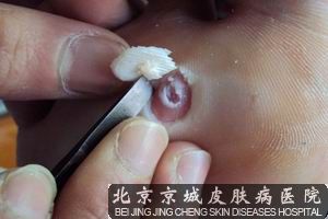 鸡眼是怎么形成的