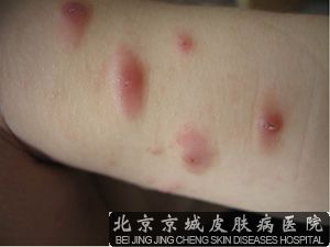丘疹性荨麻疹传染吗