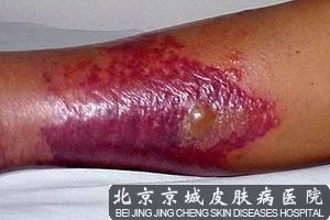 丹毒的治疗方法有哪些_北京京城皮肤病医院