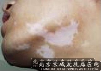哪里治疗白癜风*好