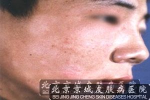 治疗白癜风的方法都有什么
