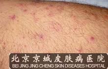 头部脂溢性皮炎治疗