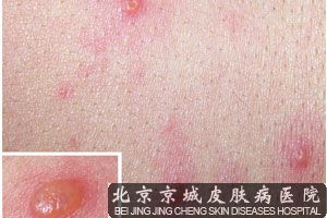 带状疱疹吃什么药