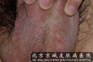 男性湿疹症状图片介绍