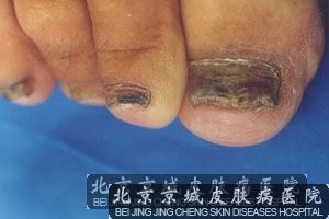 灰指甲会发生传染吗