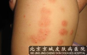 丘疹性荨麻疹的症状