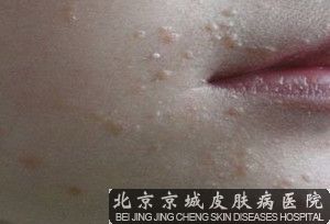 扁平疣的治疗方法有哪些