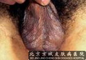 阴囊神经性皮炎是什么