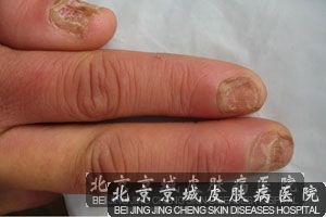 治疗灰指甲的 药是什么