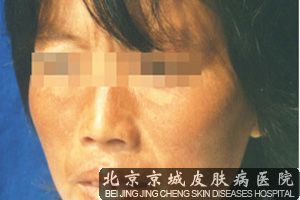 黄褐斑的特点有哪些