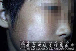 白癜风能 吗