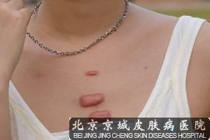 什么是瘢痕疙瘩