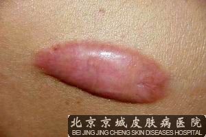北京治疗疤痕疙瘩方法医院