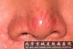 酒糟鼻怎样能 